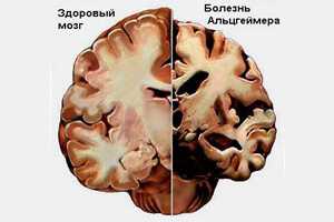 Не исключается роль мало изученных сосудистых расстройств в мозге, обнаруживаемых как в начале болезни, так и по ходу ее течения , Под воздействием этиологических факторов запускается процесс атрофии коры головного мозга, вследствие чего интеллектуальные способности больных постепенно угасают